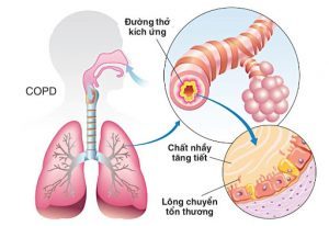 biến chứng copd trên phổi 