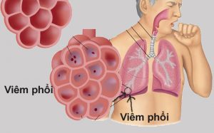 Bệnh viêm phổi có nguy hiểm không? Và cách phòng ngừa